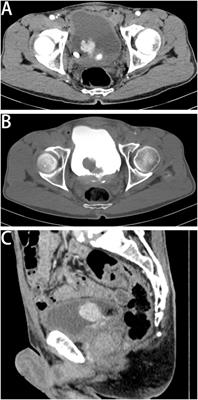 Primary Langerhans cell sarcoma in the urinary bladder: Case report and literature review